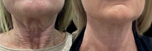 NEWEST by Mastelli – polynucleotides and hyaluronic acid skin booster for hydrated, firmer skin at Dermaline Aesthetics Berkhamsted