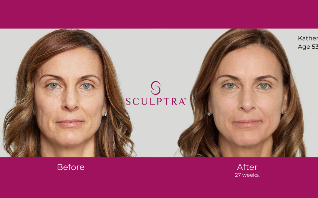 Why Sculptra Isn’t a Filler